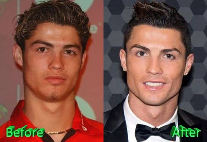 ronaldo botox