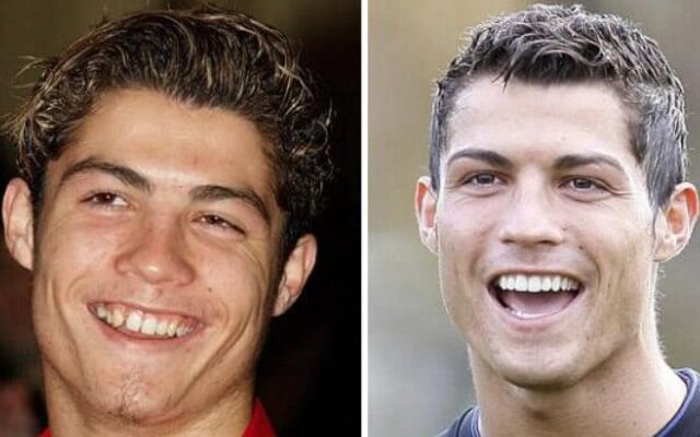 ronaldo teeth